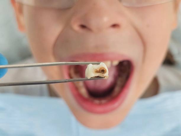 Best Chipped Tooth Repair Near Me  in Countryside, IL